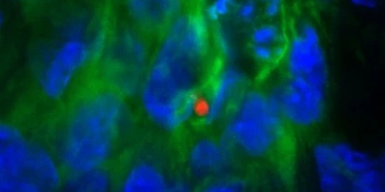 A close-up view of an atrial heart muscle cell with an ASC speck, a marker of inflammation, and a damaged nucleus using immunofluorescent microscopy imaging.