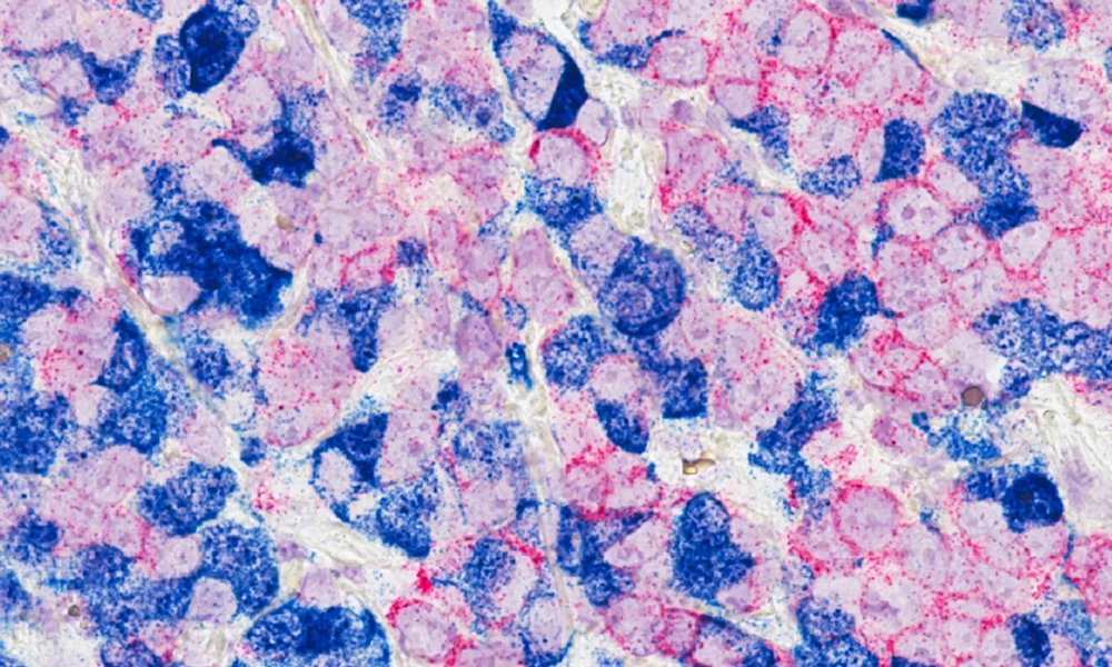 Zoomed in photograph of breast cancer cells, shown in pink and blue coloring for identification